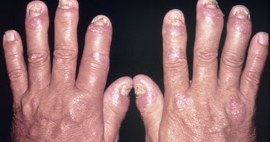 El champú a la psoriasis de la cabeza sulsena